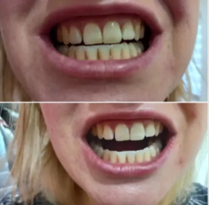 Click to view full screen Watersonic Ultrasonic Tooth Cleaner with Water Cooling photo review